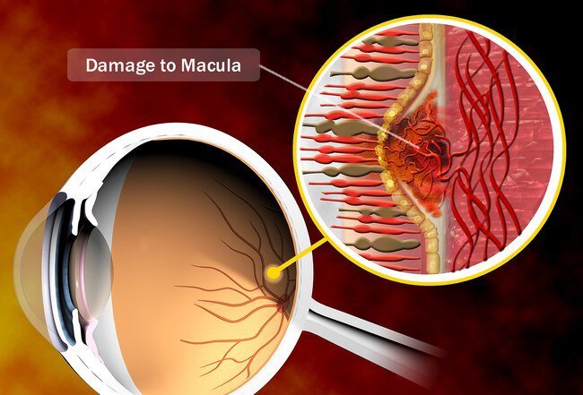 The macula is a part of the retina in the back of the eye.