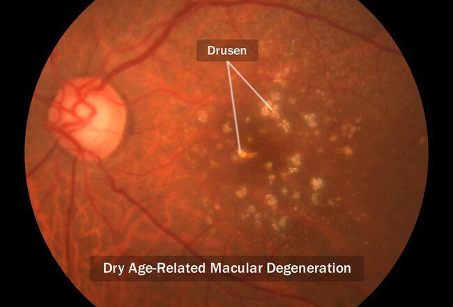 Wet and dry are the two types of macular degeneration.