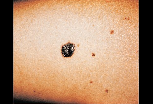 Picture of Malignant Melanoma
