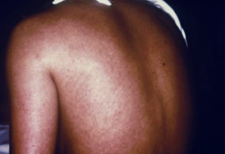 Picture: A woman with Marburg virus infection has a rash on her back