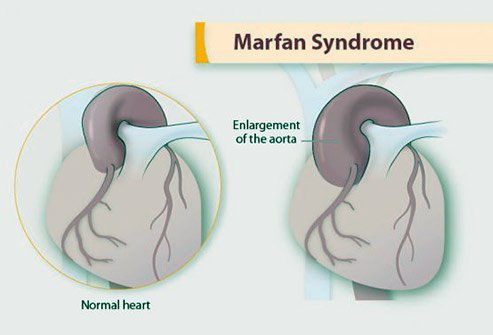 The life expectancy in this syndrome has increased to greater than 25% since 1972.