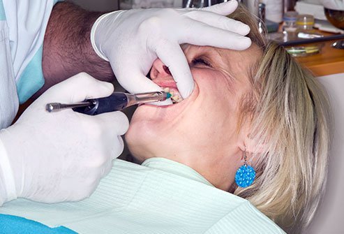A maxillary nerve block is administered to nerves near the upper bone plate of the jaw to numb the face.