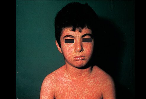 Picture of Measles