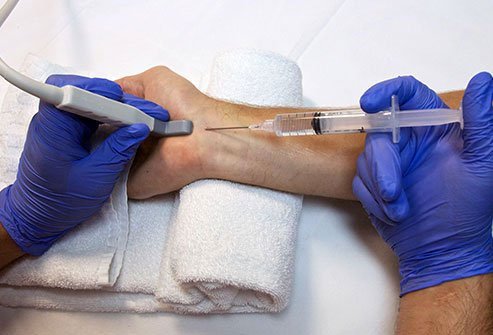 A median nerve block is a procedure to anesthetize part of the palm and fingers by injecting an anesthetic solution to numb the median nerve of the forearm. The median nerve block is often performed along with an ulnar and radial nerve block to anesthetize the whole hand and the palm.