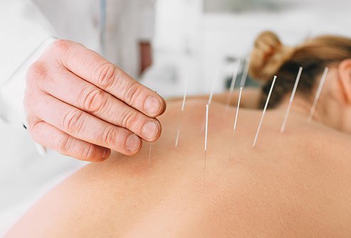 Acupuncture involves the use of small, thin needles that pierce the skin at specific acupuncture points. Acupuncture for pain relief is an alternative to over-the-counter medicines and addictive opioids.