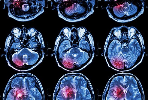 Strokes send over 60 million Americans to the hospital every year.