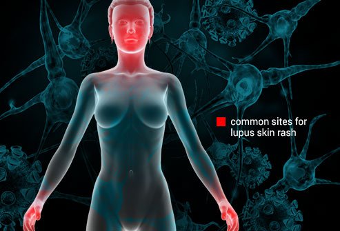 Lupus and related disorders account for more than 30 million hospital visits in the U.S. each year.
