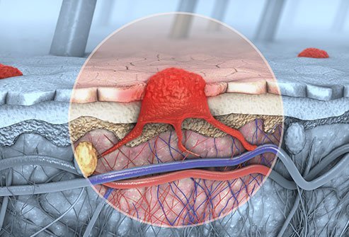 Some types of skin cancer are potentially more dangerous than others.