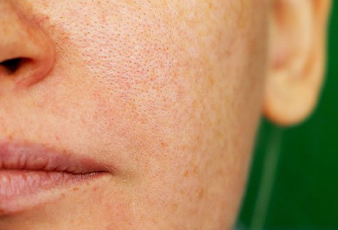 Melasma is patchy brown skin discoloration that occurs on the face.