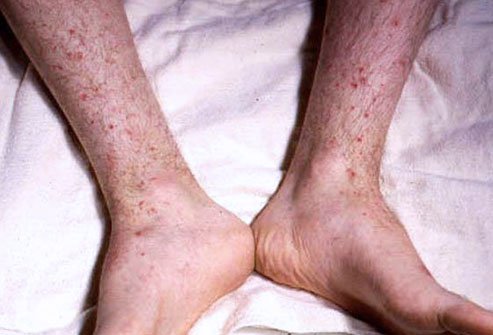 Picture of Meningococcemia