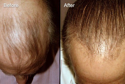Hair transplant is one treatment option for thinning hair.