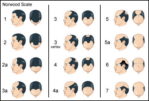 Male-pattern baldness proceeds in a predictable pattern.