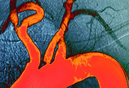 A high level of LDL cholesterol in the blood causes sticky plaque to build up in the walls of the arteries.