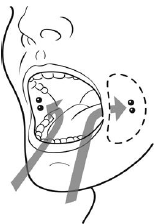 Tell the patient to place two 200 mcg misoprostol tablets in each cheek pouch - Illustration