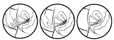 Place the tip of MILPROSA in the vaginal opening - Illustration