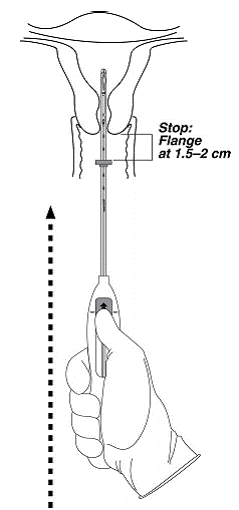 Move Mirena into the fundal position - Illustration