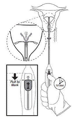 Move the slider all the way down to release
Mirena from the insertiontube - Illustration