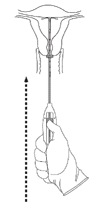 Cutting the threads - Illustration