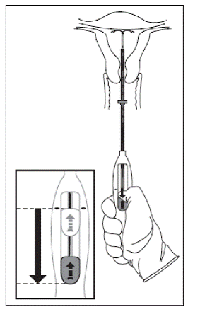 Removal of Mirena - Illustration