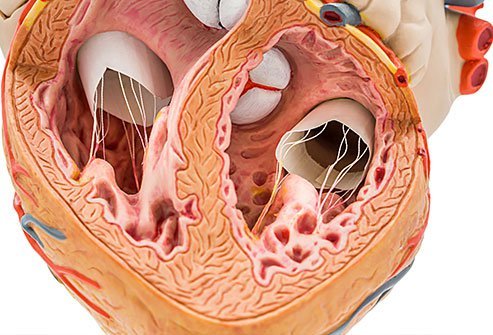 The heart's mitral valve is subject to hardening or stenosis as a symptom of heart disease. Mitral valvuloplasty uses a catheter to inflate a balloon inside the valve, stretching it and ideally improving its function.