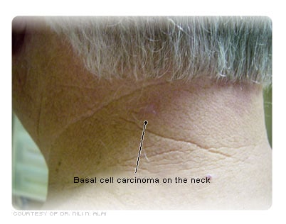 Basal cell carcinoma on the neck