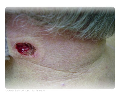 Site after the tumor roots were cleared