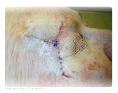 Sutured wound