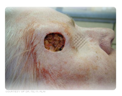 Intra-op wound