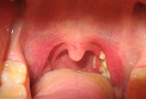 A person diagnosed with mono shows the signs of a reddened sore throat and whitish coating on the tonsils.