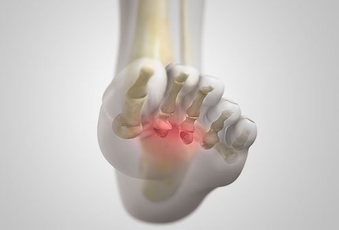 Morton's neuroma produces symptoms of metatarsalgia or ball of foot pain.