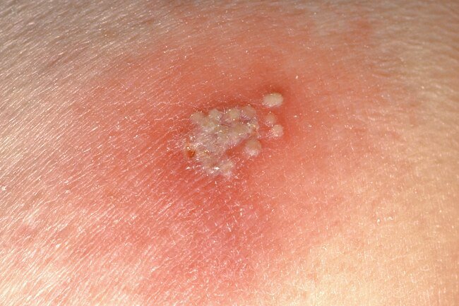Herpes simplex 2 (HSV-2) causes most genital herpes, but HSV-1 type can cause it, too.
