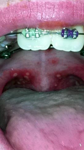 Picture of characteristic mouth sores of hand foot and mouth disease