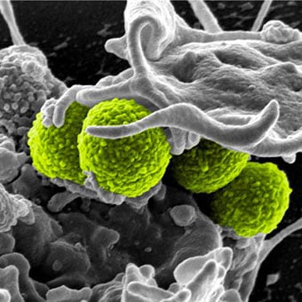 This digitally colorized scanning electron micrograph (SEM) depicts four green-colored, spheroid-shaped methicillin-resistant Staphylococcus aureus (MRSA) bacteria as they were in the process of being enveloped by a much larger human white blood cell.