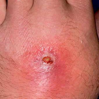 Abscess and cellulitis from a methicillin-resistant Staphylococcus aureus (MRSA) hand infection.