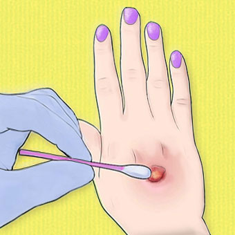 An illustration shows a doctor taking a sample of pus from a wound to have it tested for MRSA.