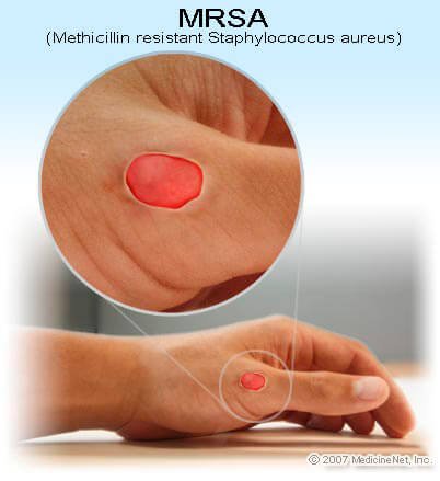 Picture of MRSA (methicillin-resistant Staphylococcus aureus) Infection