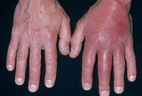 Often, the first indication of MRSA infection is a spread of the infection into the surrounding skin.