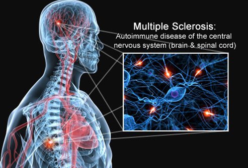 Multiple sclerosis (MS) is an autoimmune disease in which the body's immune system attacks its own central nervous system (the brain and spinal cord).