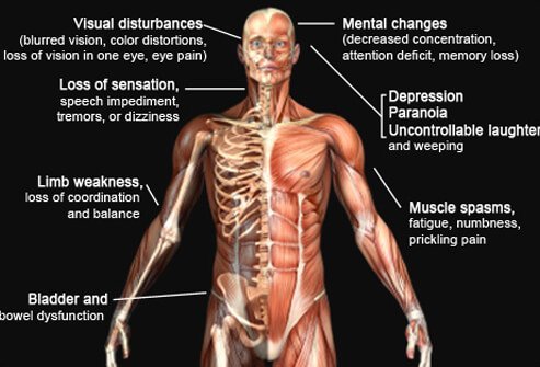 Illustration displaying the areas affected by the symptoms of multiple sclerosis.