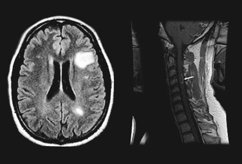 One of the main ways to diagnose multiple sclerosis is an MRI (magnetic resonance imaging) scan.