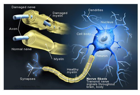 By attacking myelin, the immune system in a person with MS causes inflammation and degeneration of the myelin that can lead to demyelination.