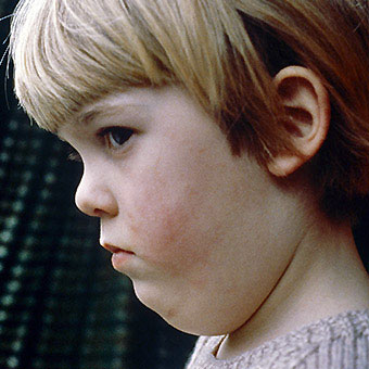 A child suffers from mumps.