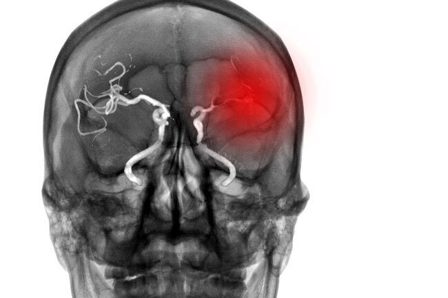 Sudden muscle weakness may be a sign of a stroke. 