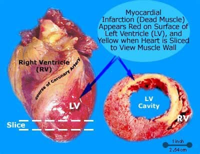 Picture of Myocardial Infarction Caused by Heart Attack