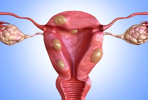 Recovery from myomectomy can take between 4-6 weeks.
