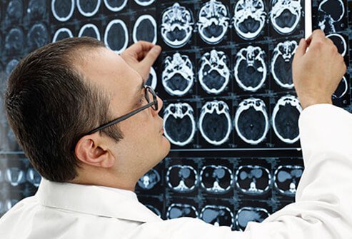 Some research has shown that moderate severe traumatic brain injury (TBI) can increase the risk of an individual developing Alzheimer's disease or another type of dementia, even years after the initial injury.
