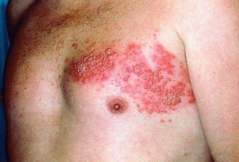 When you have chickenpox, the virus that caused it sticks around, even after you get better.