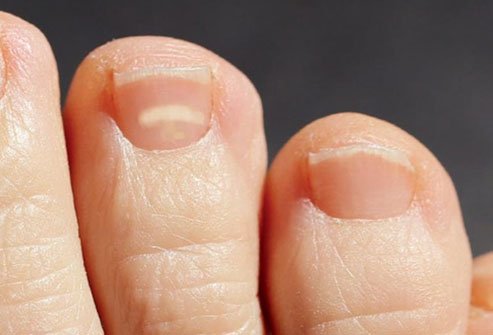 White spots on nails are common and usually harmless.