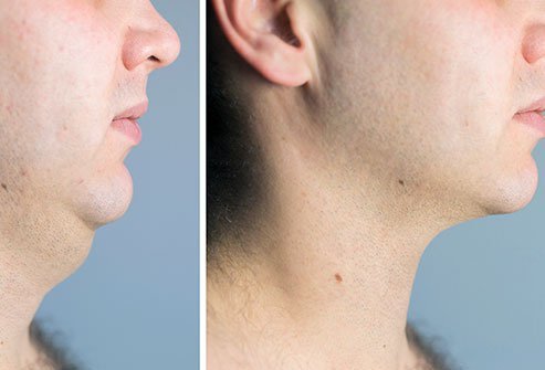 Facial fat treatment