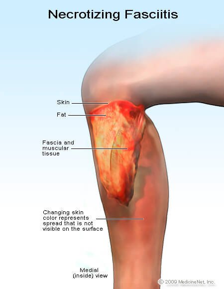 Picture of necrotizing fasciitis (flesh-eating disease)